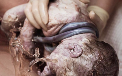 Cordão umbilical enrolado no pescoço do bebê é perigoso?
