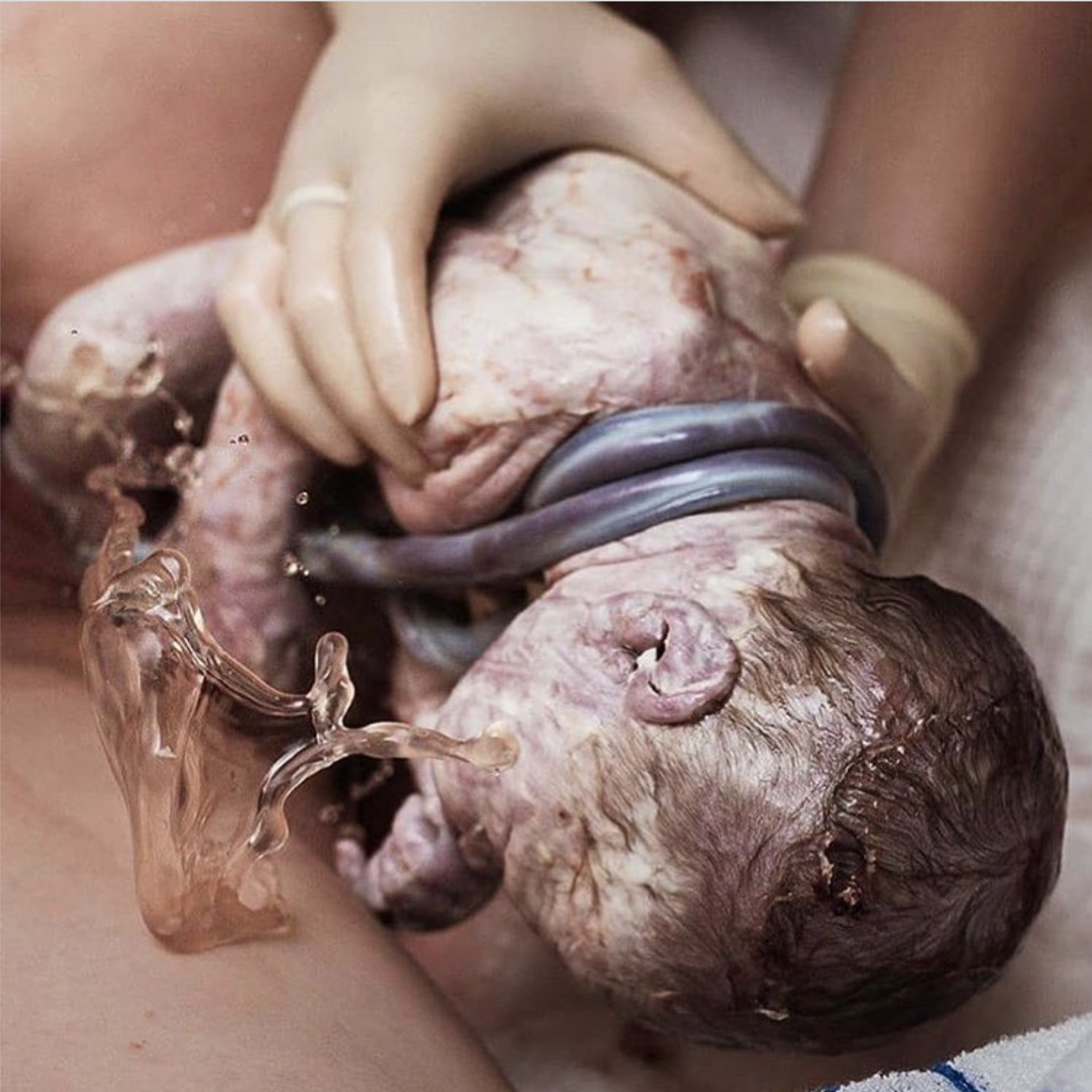 Cordão umbilical enrolado no pescoço do bebê é perigoso?